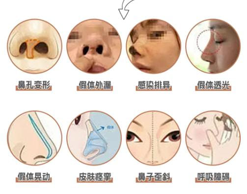首尔礼愫整形外科鼻修复怎么样？鞠元硕院长主攻假体取出重建，面诊费3万韩元！BeautsGO APP支持在线预约院长